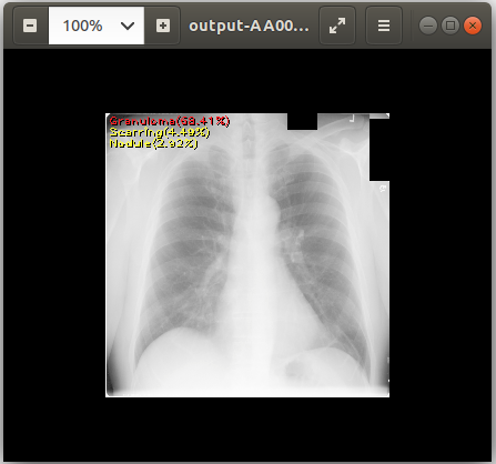 chest_xray_example_output.png